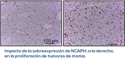 Demostrada la participación del gen NCAPH en el mal pronóstico y evolución del cáncer de mama de tipo luminal A.