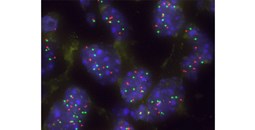 Descubierta una nueva vulnerabilidad en el cáncer de pulmón que abre vías para terapias personalizadas