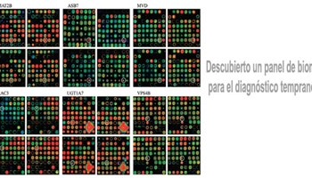 Descubierto un panel de biomarcadores (autoanticuerpos) para el diagnóstico temprano de la osteoartritis de rodilla (1)