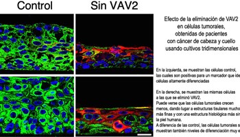 Un estudio identifica moléculas clave para el desarrollo y evolución de propiedades malignas de los cánceres de cabeza y cuello