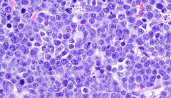 Estrechando el cerco a la leucemia infantil