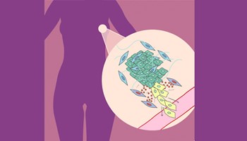 La sobreexpresión del gen SNAI2 en el estroma se asocia con un mal pronóstico en el cáncer de mama luminal B HER2-positivo