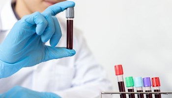 El Centro de Investigación del Cáncer pone las bases para el desarrollo del diagnóstico precoz de leucemia mediante un estudio observacional de la población