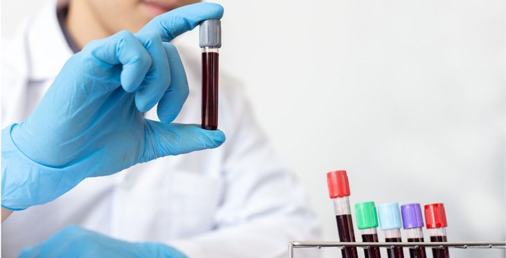 El Centro de Investigación del Cáncer pone las bases para el desarrollo del diagnóstico precoz de leucemia mediante un estudio observacional de la población