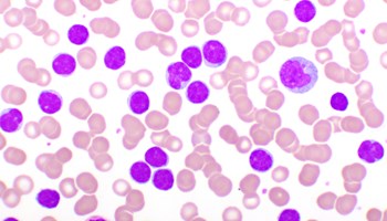 Definida nueva variable para evaluar pronóstico de leucemia linfática crónica