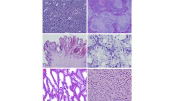Descubierto un nuevo gen inductor de cáncer y sus debilidades terapéuticas