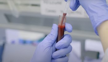 Establecidas las bases para la detección precoz de la leucemia linfática crónica