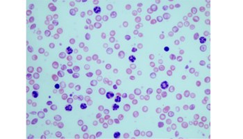 La proteína SOS1 es necesaria para el desarrollo de la leucemia mieloide crónica