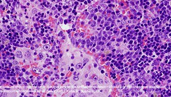 Demostrada la alteración genética en el gen VAV1 que determina la aparición de linfomas y cáncer de pulmón