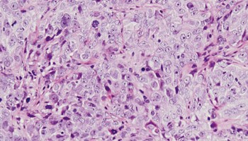 Identificada una vía molecular implicada en cáncer de ovario y en la generación de resistencias en esta enfermedad.