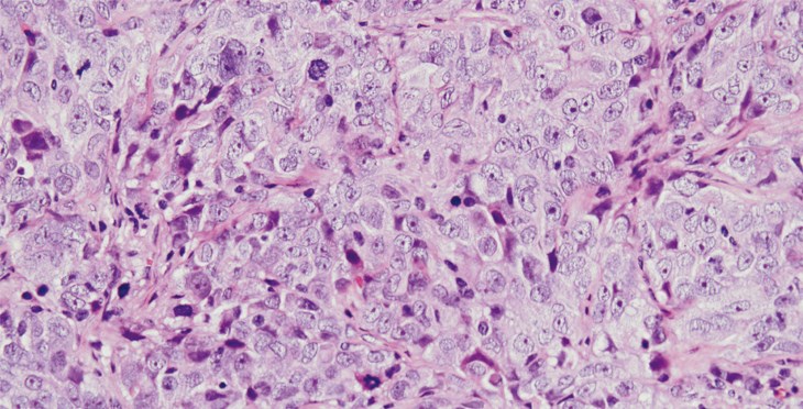 Identificada una vía molecular implicada en cáncer de ovario y en la generación de resistencias en esta enfermedad.
