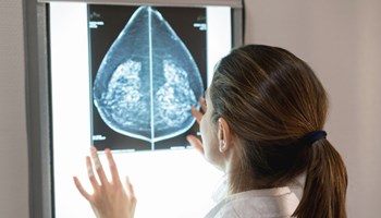 El Centro de Investigación del Cáncer diseña un predictor de riesgo para cáncer de mama que mejora los test comerciales usados en clínica