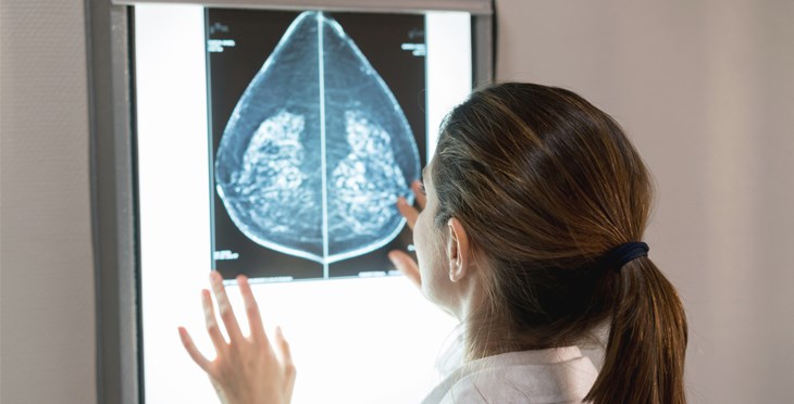 El Centro de Investigación del Cáncer diseña un predictor de riesgo para cáncer de mama que mejora los test comerciales usados en clínica