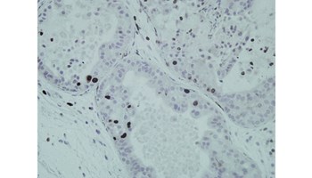 Nuevo avance contra el cáncer de próstata y la resistencia a los tratamientos oncológicos