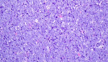 Mejora la comprensión de la evolución de leucemia linfoblástica aguda de células B en niños con predisposición a desarrollarla