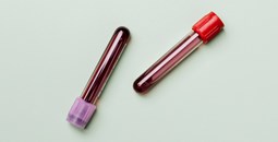 Descritas nuevas similitudes entre pacientes con COVID graves y pacientes con linfocitosis B monoclonal de bajo recuento.