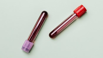 Descritas nuevas similitudes entre pacientes con COVID graves y pacientes con linfocitosis B monoclonal de bajo recuento.