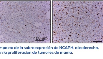 Demostrada la participación del gen NCAPH en el mal pronóstico y evolución del cáncer de mama de tipo luminal A.