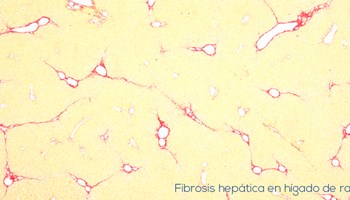 Demostrada la relación entre el daño hepático crónico y el receptor del factor de crecimiento epidérmico