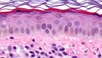 El sistema inmune está involucrado en el desarrollo de la mastocitosis
