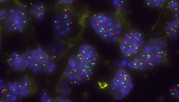 Un nuevo enfoque terapéutico para el cáncer de pulmón con mutaciones en KRAS