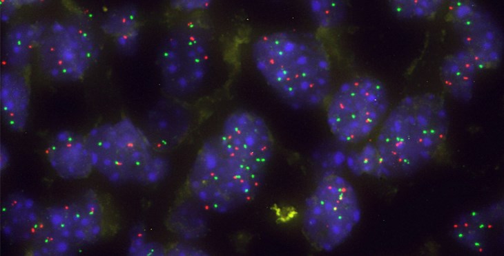 Un nuevo enfoque terapéutico para el cáncer de pulmón con mutaciones en KRAS