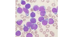 Investigadores del CIC participan en un proyecto internacional para identificar biomarcadores epigenéticos que detecten precozmente el riesgo de leucemia infantil