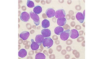 Investigadores del CIC participan en un proyecto internacional para identificar biomarcadores epigenéticos que detecten precozmente el riesgo de leucemia infantil