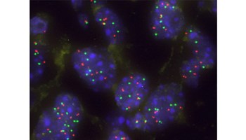 Descubierta una nueva vulnerabilidad en el cáncer de pulmón que abre vías para terapias personalizadas