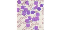 Científicos del Centro de Investigación del Cáncer desvelan cómo una lesión genética concreta impulsa la leucemia linfoblástica aguda B