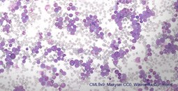 Un fármaco experimental potencia los tratamientos contra la leucemia mieloide crónica
