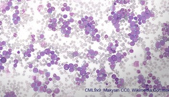 Un fármaco experimental potencia los tratamientos contra la leucemia mieloide crónica